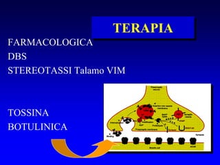 TERAPIA
FARMACOLOGICA
DBS
STEREOTASSI Talamo VIM
TOSSINA
BOTULINICA
 