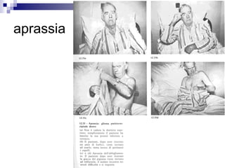 aprassia
 