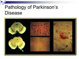 Pathology of Parkinson’s
Disease
 