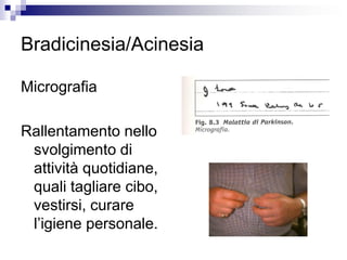 Bradicinesia/Acinesia
Micrografia
Rallentamento nello
svolgimento di
attività quotidiane,
quali tagliare cibo,
vestirsi, curare
l’igiene personale.
 