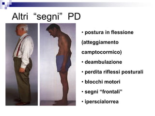 Altri “segni” PD
• postura in flessione
(atteggiamento
camptocormico)
• deambulazione
• perdita riflessi posturali
• blocchi motori
• segni “frontali”
• iperscialorrea
 