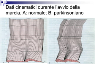 Dati cinematici durante l’avvio della
marcia. A: normale; B: parkinsoniano
 