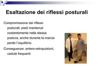 Esaltazione dei riflessi posturali
Compromissione dei riflessi
posturali: piedi mantenuti
costantemente nella stessa
postura, anche durante la marcia
perde l’equilibrio.
Conseguenze: antero-retropulsioni,
cadute frequenti.
 