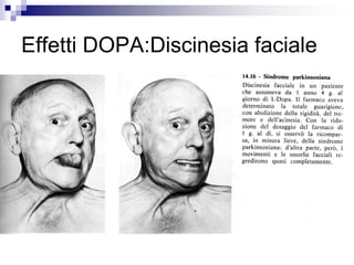 Effetti DOPA:Discinesia faciale
 