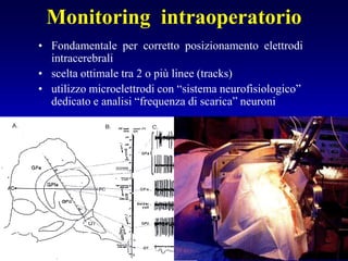 Monitoring intraoperatorio
• Fondamentale per corretto posizionamento elettrodi
intracerebrali
• scelta ottimale tra 2 o più linee (tracks)
• utilizzo microelettrodi con “sistema neurofisiologico”
dedicato e analisi “frequenza di scarica” neuroni
 