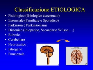 Classificazione ETIOLOGICA
• Fisiologico (fisiologico accentuato)
• Essenziale (Familiare e Sporadico)
• Parkinson e Parkinsonismi
• Distonico (Idiopatico, Secondario Wilson….)
• Rubrale
• Cerebellare
• Neuropatico
• Iatrogeno
• Funzionale
 