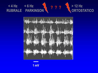 1 mV
< 4 Hz < 6 Hz > 12 Hz
RUBRALE PARKINSON ORTOSTATICO
? ? ?
 