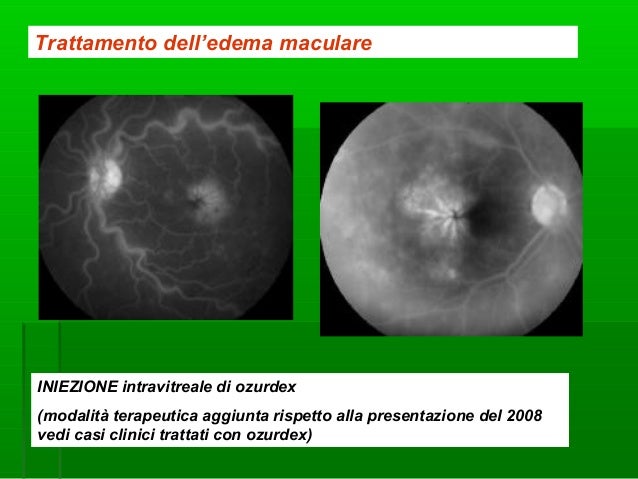 Operazione su un varicosity
