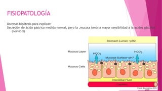 FISIOPATOLOGÍA
Diversas hipótesis para explicar:
Secreción de ácido gástrico medida normal, pero la ,mucosa tendría mayor sensibilidad a la acidez gástrica
(nervio X)
 
