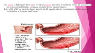 Una úlcera es toda lesión de la piel o membrana mucosa con forma crateriforme (forma de un cráter, al
perderse parte del tejido) y con escasa o nula tendencia a la cicatrización
Entre el 30 y 50% los pacientes tienen gastritis por H. pylori ( relación no establecida por lo asintomático
en relación a la dispepsia no ulcerosa)
 