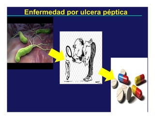 Enfermedad por ulcera péptica

 
