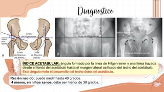 displasia-congenita-de-cadera.pdf huhyhh | PDF