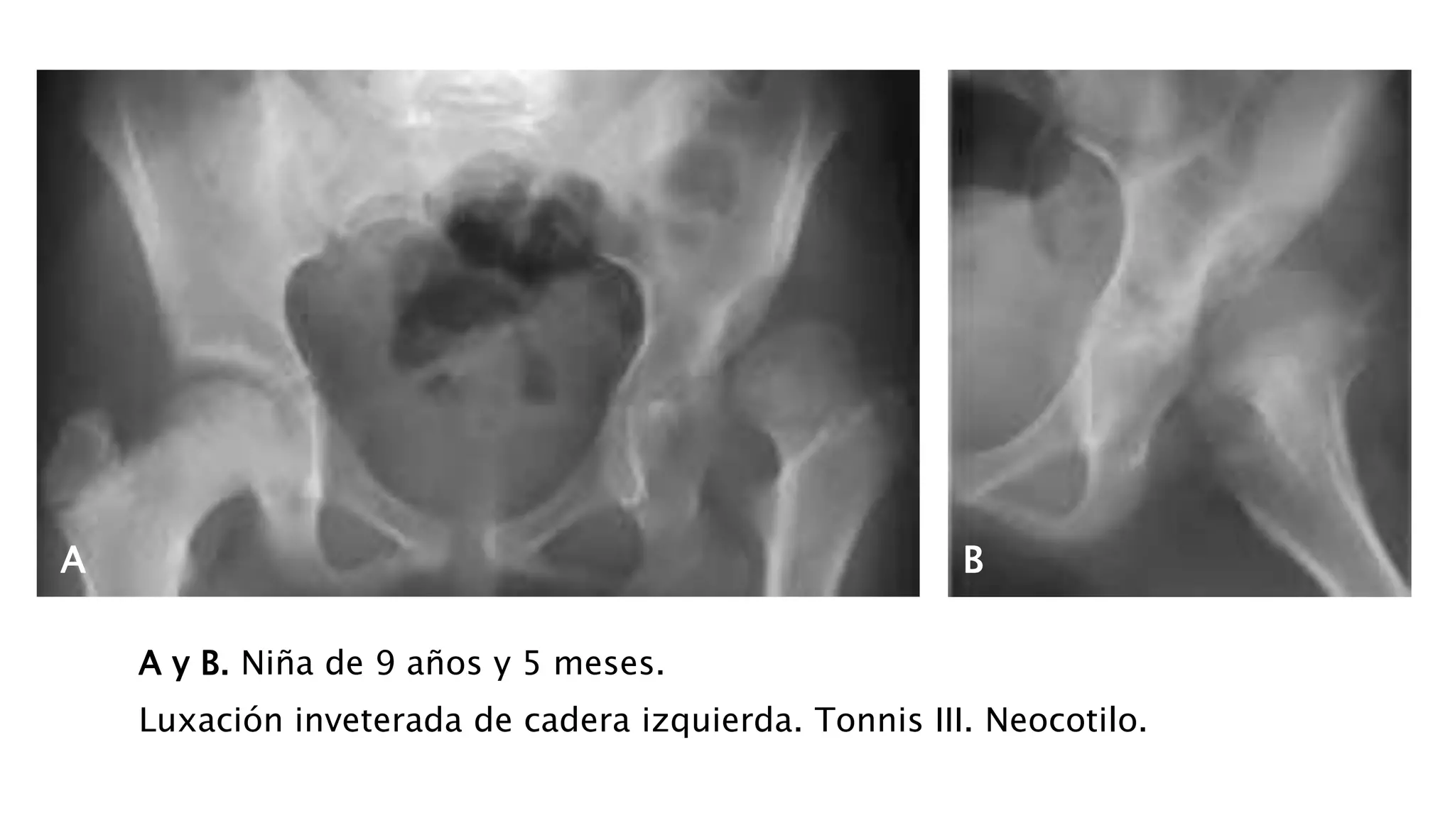 Displasia de-cadera | PPTX | Pregnancy | Reproductive Health