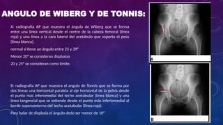 displasia de cadera una presentacion del tema | PPTX