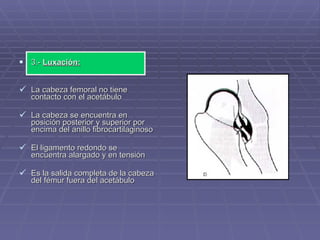 3.-  Luxación: La cabeza femoral no tiene contacto con el acetábulo La cabeza se encuentra en posición posterior y superior por encima del anillo fibrocartilaginoso El ligamento redondo se encuentra alargado y en tensión  Es la salida completa de la cabeza del fémur fuera del acetábulo 