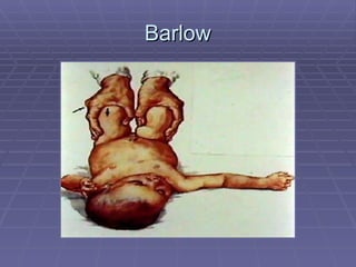 Barlow 