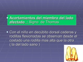 Acortamientos del miembro del lado afectado  :  Signo  de Thomas Con el niño en decúbito dorsal caderas y rodillas flexionadas se observan desde el costado una rodilla mas alta que la otra  ( la del lado sano ) 