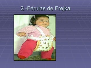 2.-Férulas de Frejka 