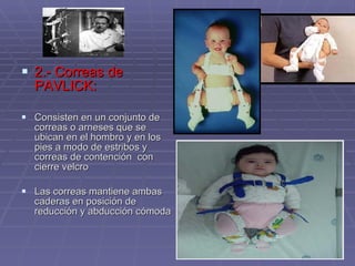 2.- Correas de PAVLICK: Consisten en un conjunto de correas o arneses que se ubican en el hombro y en los pies a modo de estribos y correas de contención  con cierre velcro Las correas mantiene ambas caderas en posición de reducción y abducción cómoda 