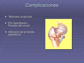 Complicaciones Necrosis avascular Por hiperflexión :  Paresia del crural Infección de la herida operatoria 