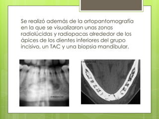Se realizó además de la ortopantomografía
en la que se visualizaron unas zonas
radiolúcidas y radiopacas alrededor de los
ápices de los dientes inferiores del grupo
incisivo, un TAC y una biopsia mandibular.
 