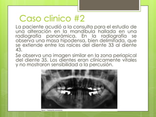 Caso clinico #2
La paciente acudió a la consulta para el estudio de
una alteración en la mandíbula hallada en una
radiografía panorámica. En la radiografía se
observa una masa hipodensa, bien delimitada, que
se extiende entre las raíces del diente 33 al diente
43.
Se observa una imagen similar en la zona periapical
del diente 35. Los dientes eran clínicamente vitales
y no mostraron sensibilidad a la percusión.
 