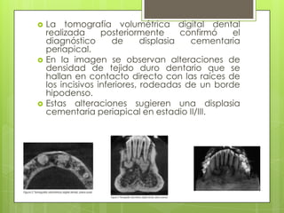    La tomografía volumétrica digital dental
    realizada      posteriormente       confirmó  el
    diagnóstico       de      displasia   cementaria
    periapical.
   En la imagen se observan alteraciones de
    densidad de tejido duro dentario que se
    hallan en contacto directo con las raíces de
    los incisivos inferiores, rodeadas de un borde
    hipodenso.
   Estas alteraciones sugieren una displasia
    cementaria periapical en estadio II/III.
 