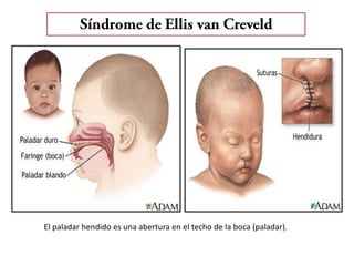 El paladar hendido es una abertura en el techo de la boca (paladar).
 