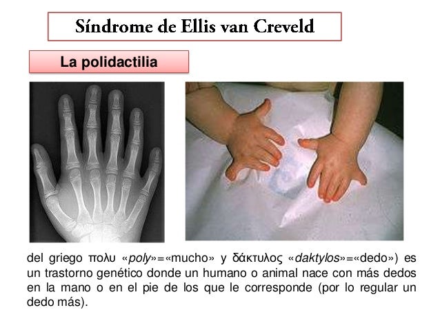 SINDROME DE ELLIS VAN CREVELD PDF