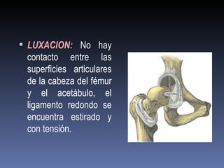  LUXACION: No hay
 contacto entre las
 superficies articulares
 de la cabeza del fémur
 y el acetábulo, el
 ligamento redondo se
 encuentra estirado y
 con tensión.
 