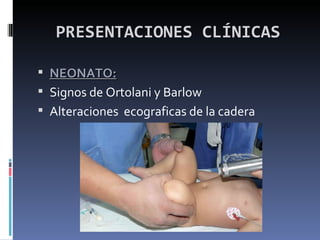 PRESENTACIONES CLÍNICAS

 NEONATO:
 Signos de Ortolani y Barlow
 Alteraciones ecograficas de la cadera
 