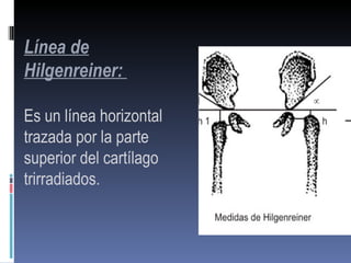 Línea de
Hilgenreiner:

Es un línea horizontal
trazada por la parte
superior del cartílago
trirradiados.
 