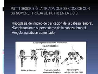 PUTTI DESCRIBIÓ LA TRIADA QUE SE CONOCE CON
SU NOMBRE (TRIADA DE PUTTI) EN LA L.C.C.:

•Hipoplasia del núcleo de osificación de la cabeza femoral.
•Desplazamiento superoexterno de la cabeza femoral.
•Angulo acetabular aumentado.
 