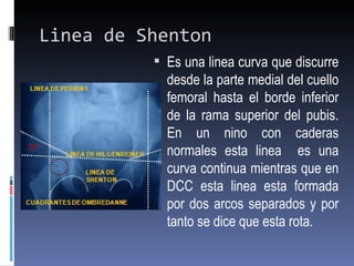 Linea de Shenton
           Es una linea curva que discurre
            desde la parte medial del cuello
            femoral hasta el borde inferior
            de la rama superior del pubis.
            En un nino con caderas
            normales esta linea es una
            curva continua mientras que en
            DCC esta linea esta formada
            por dos arcos separados y por
            tanto se dice que esta rota.
 