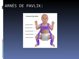 ARNÉS DE PAVLIK:
 