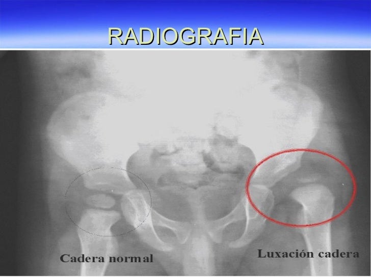 images Niño Radiografia De Cadera Normal En Bebes displasia congenita de cadera pediatria