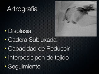 Artrografía


• Displasia
• Cadera Subluxada
• Capacidad de Reduccir
• Interposicipon de tejido
• Seguimiento
 