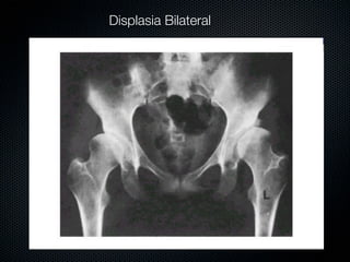 Displasia Bilateral
 