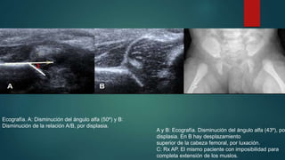 Ecografía. A: Disminución del ángulo alfa (50º) y B: 
Disminución de la relación A/B, por displasia. 
A y B: Ecografía. Disminución del ángulo alfa (43º), por 
displasia. En B hay desplazamiento 
superior de la cabeza femoral, por luxación. 
C: Rx AP. El mismo paciente con imposibilidad para 
completa extensión de los muslos. 
 