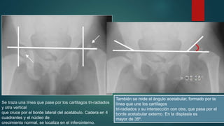 Se traza una línea que pase por los cartílagos tri-radiados 
y otra vertical 
que cruce por el borde lateral del acetábulo. Cadera en 4 
cuadrantes y el núcleo de 
crecimiento normal, se localiza en el inferointerno. 
También se mide el ángulo acetabular, formado por la 
línea que une los cartílagos 
tri-radiados y su intersección con otra, que pasa por el 
borde acetabular externo. En la displasia es 
mayor de 35º. 
 