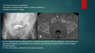 Las mas comunes son lesiones 
vasculares (Arterias iliaca interna y glútea superior) y 
urológicas (Uretra y vejiga). 
Rx AP. Diastasis de la sínfisis púbica y sacroiliaca izquierda. (Flecha delgada). Hay luxofractura 
del pubis izquierdo, con hematoma en la pelvis, que comprime la parte posterior de la vejiga. 
(Flecha gruesa). 
B: TAC corte axial. Luxofractura del pubis izquierdo. 
 