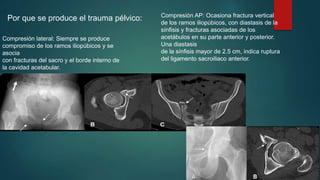 Por que se produce el trauma pélvico: Compresión AP: Ocasiona fractura vertical 
Compresión lateral: Siempre se produce 
compromiso de los ramos iliopúbicos y se 
asocia 
con fracturas del sacro y el borde interno de 
la cavidad acetabular. 
de los ramos iliopúbicos, con diastasis de la 
sínfisis y fracturas asociadas de los 
acetábulos en su parte anterior y posterior. 
Una diastasis 
de la sínfisis mayor de 2.5 cm, indica ruptura 
del ligamento sacroiliaco anterior. 
 
