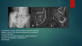 Compresión vertical: caída de altura cayendo sobre las 
nalgas o de pie. Hay lesiones calcáneos y la columna. 
Ocurren fracturas 
verticales en los ramos iliopúbicos, región posterior y 
superior del acetábulo y diastasis de 
sacroiliacas. 

