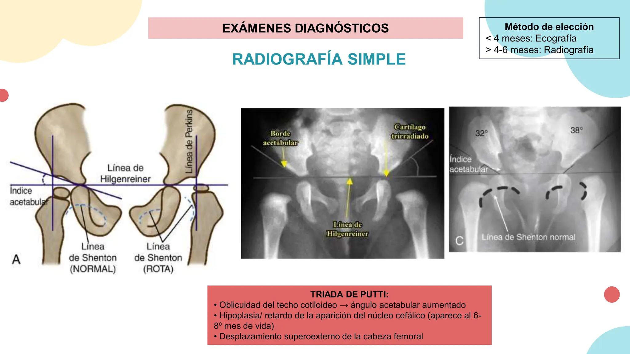 Putti Py DISPLASIA DE CADERA EN PEDIATRIA UPAO MEDICINA | PPTX