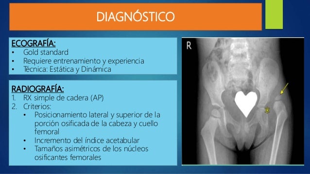 Displasia de desarrollo de cadera/ Luxación Congénita de Cadera