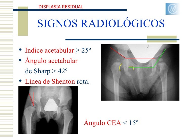Displasia de desarrollo (dr arbona)