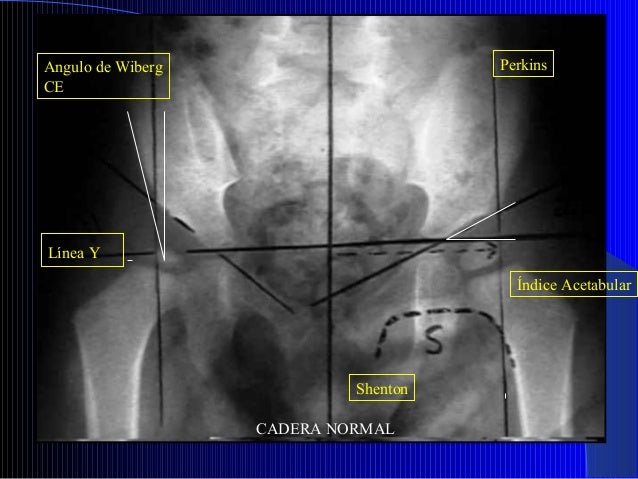 Displasia de la cadera en desarrollo