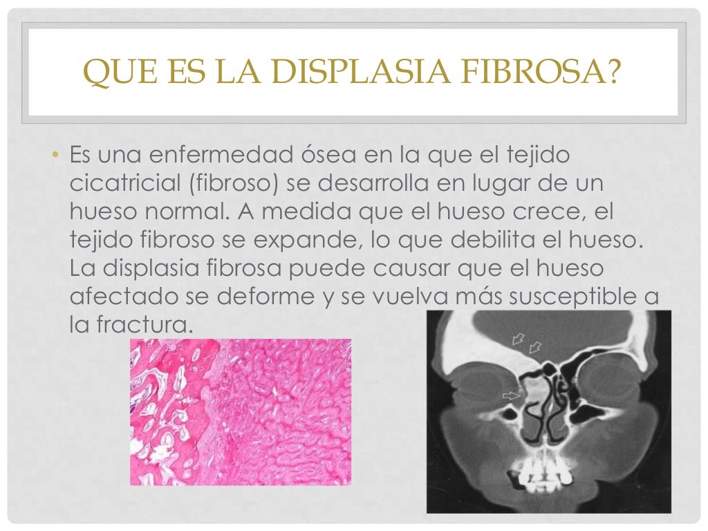 Displasia fibrosa