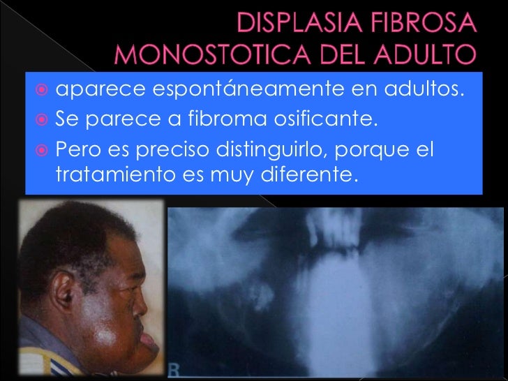 Displasia fibrosa