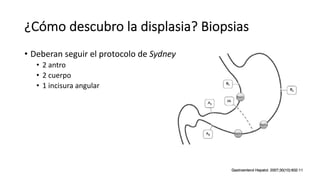 ¿Cómo descubro la displasia? Biopsias
• Deberan seguir el protocolo de Sydney
• 2 antro
• 2 cuerpo
• 1 incisura angular
 